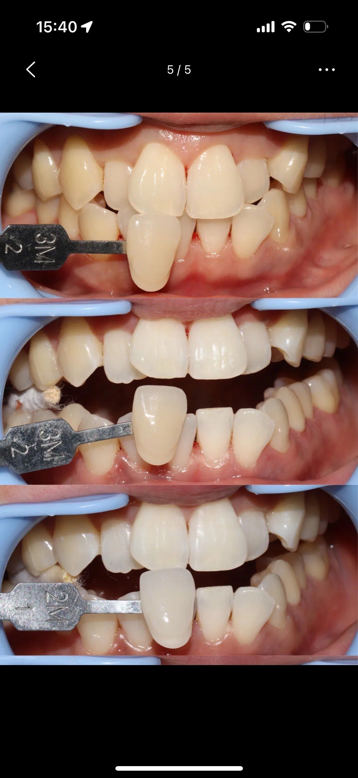 虽然牙齿不齐但是他可以白呀
今天又