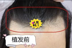 -大麦微针植发全国连锁