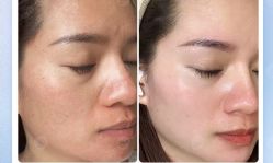 -美肤盾祛痘·问题肌头疗管理中心