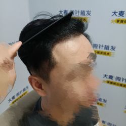 -大麦微针植发丨全国连锁