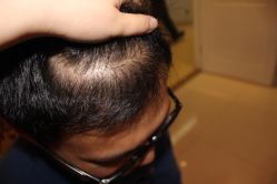 -大麦微针植发丨全国连锁