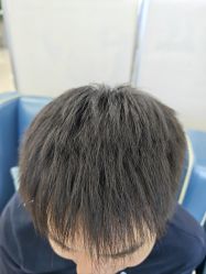 -大麦微针植发全国连锁