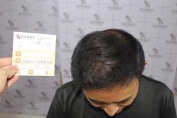 -大麦微针植发丨全国连锁