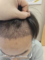 -大麦微针植发全国连锁