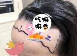 -大麦微针植发全国连锁