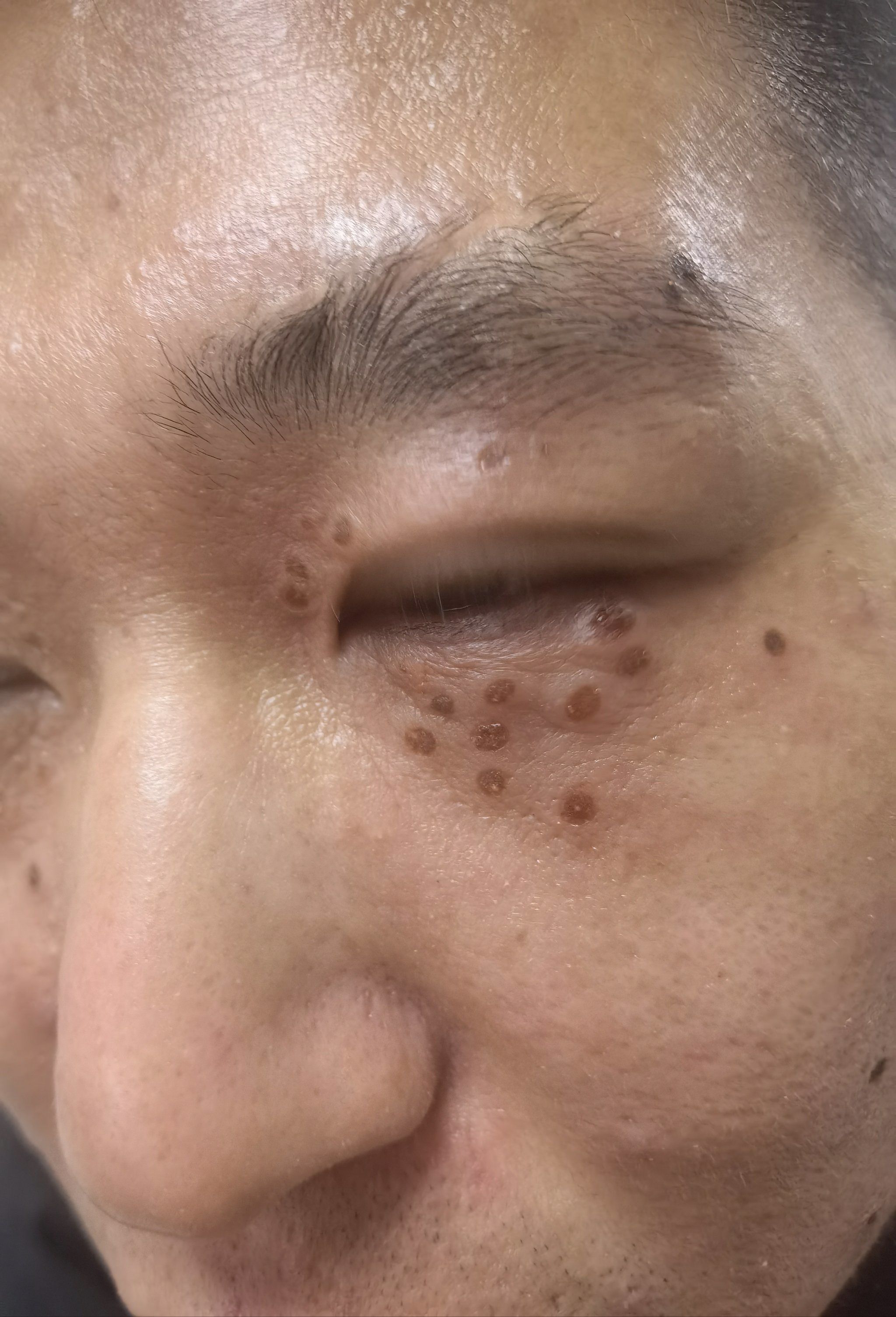 汗管瘤