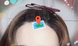 -大麦微针植发全国连锁