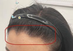 -大麦微针植发全国连锁