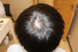 -大麦微针植发丨全国连锁