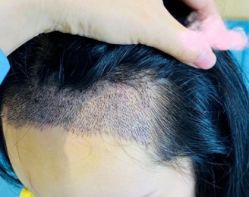 -大麦微针植发丨全国连锁