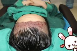 点击看大图 -大麦微针植发丨全国连锁