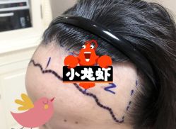 -大麦微针植发全国连锁