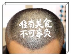 -大麦微针植发全国连锁