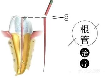 关于根管治疗，你了解多少？