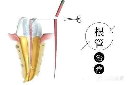 关于根管治疗,你了解多少?