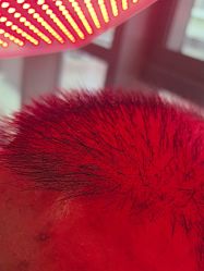 -碧莲盛·不剃发植发