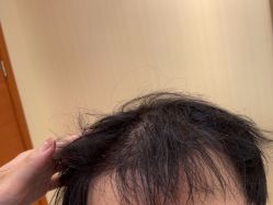 -碧莲盛·不剃发植发