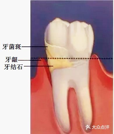 矫牙前做的这个收费项目，不做后果很严重