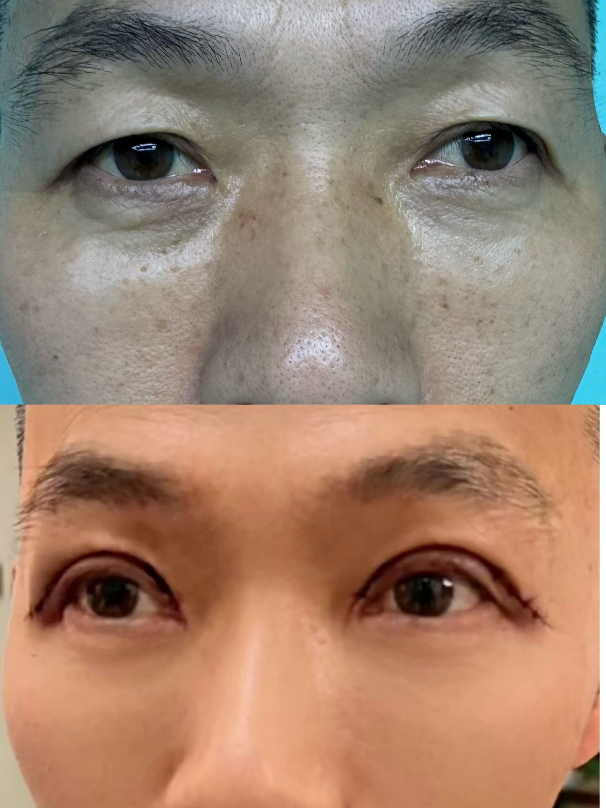 割双眼皮前后对比