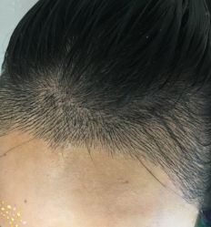 -大麦微针植发丨全国连锁