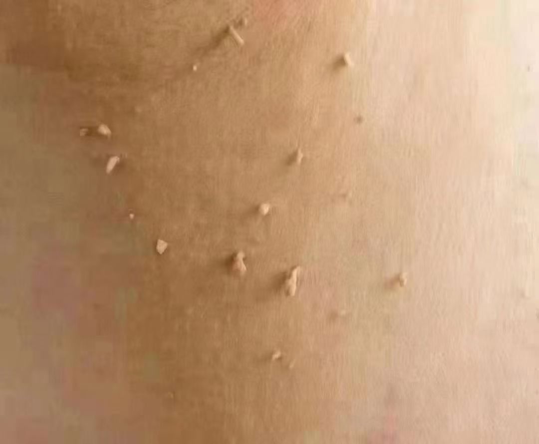 脖子上的,这种凸起物叫丝状疣,是一种hp