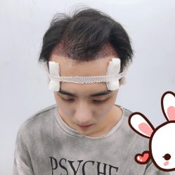 -大麦微针植发丨全国连锁