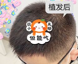 -大麦微针植发全国连锁