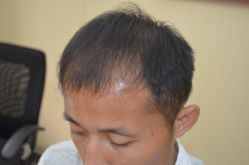 -大麦微针植发丨全国连锁