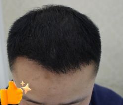 -大麦微针植发丨全国连锁