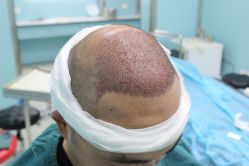 点击看大图 -大麦微针植发丨全国连锁