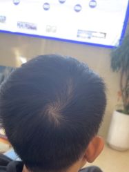 -大麦微针植发全国连锁