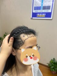 -大麦微针植发全国连锁