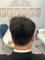 体验后-大麦微针植发全国连锁
