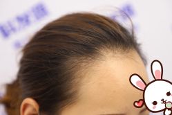 -大麦微针植发丨全国连锁