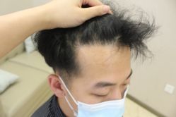 -大麦微针植发丨全国连锁