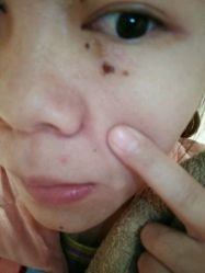第10天，陆续掉珈-美丽人生祛斑扁平疣汗管瘤中心