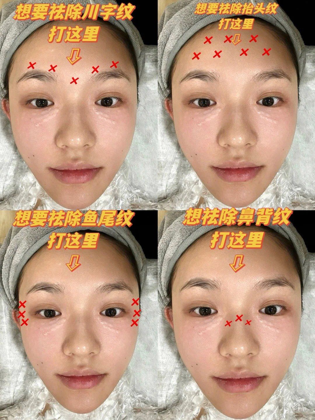 超全的肉毒素高阶和隐藏打法