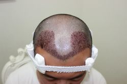 点击看大图 -大麦微针植发丨全国连锁