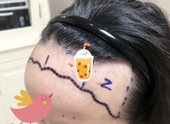 -大麦微针植发全国连锁