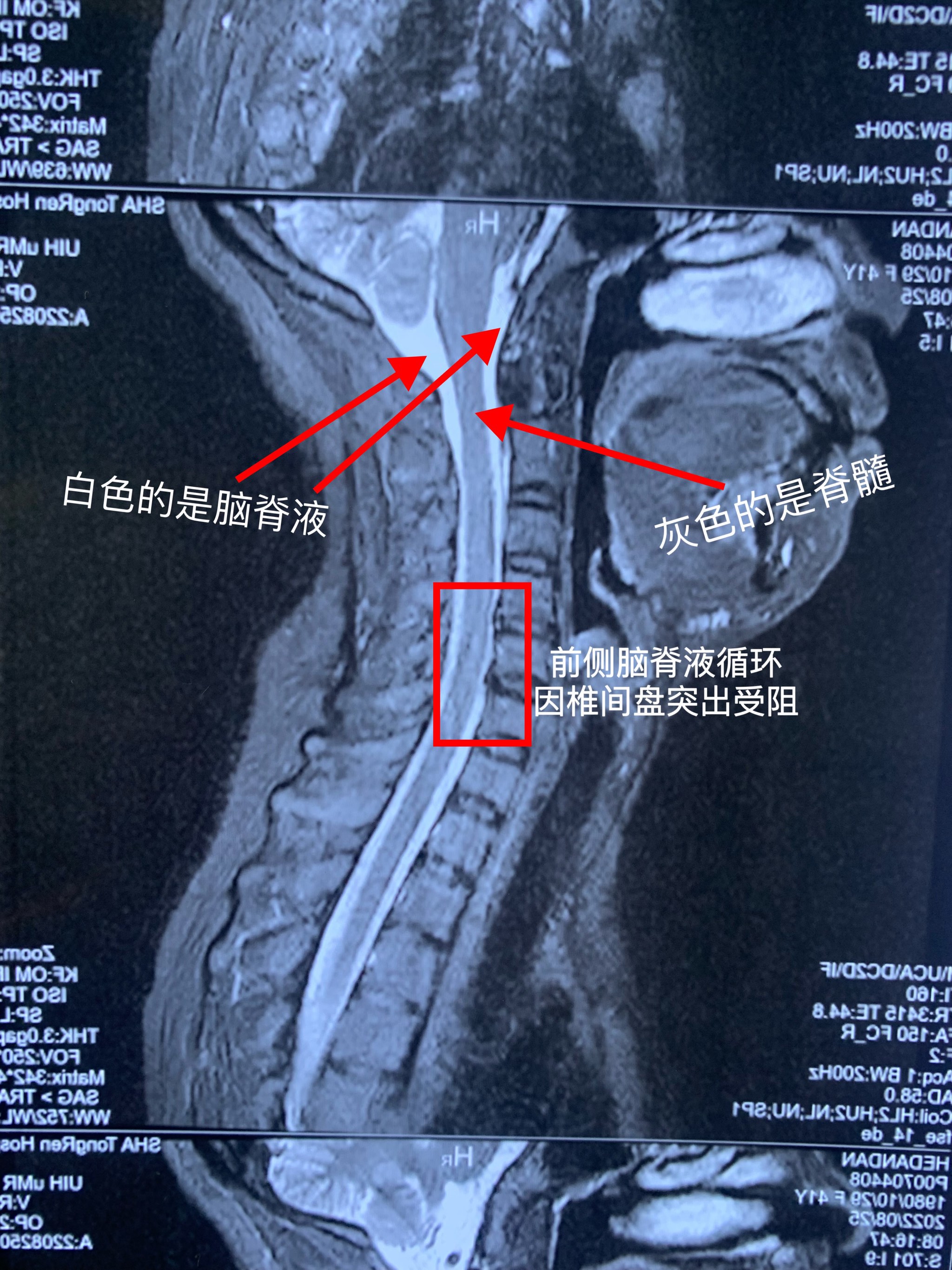 颈椎五六七节压迫神经图片