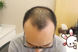 -大麦微针植发丨全国连锁