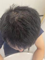 -大麦微针植发全国连锁