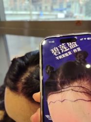 -碧莲盛·不剃发植发