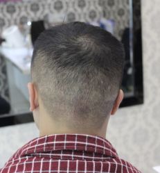 -大麦微针植发全国连锁