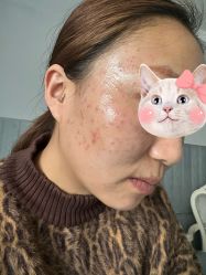 -爱莎扁平疣·汗管瘤·斑痣中心