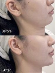 体验前-杭州米兰柏羽医疗美容医院