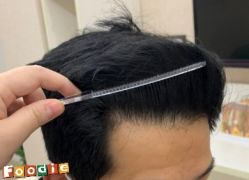 -大麦微针植发丨全国连锁