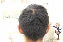 -大麦微针植发丨全国连锁