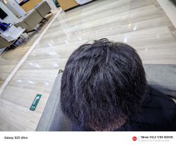 体验后-雍禾植发全国连锁