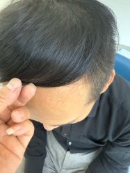 -大麦微针植发全国连锁